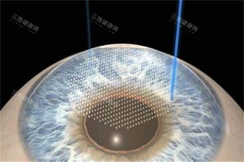 湘雅二医院眼科2025近视手术价格表:半飞秒|全飞秒|ICL晶体植入收费价目表一览！