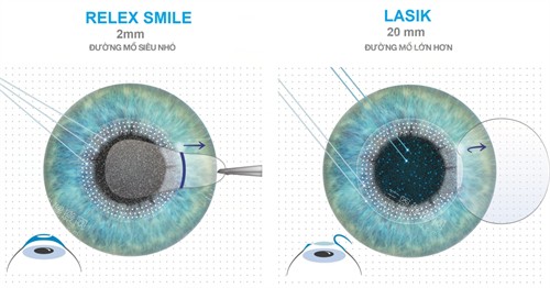 2025年科大眼科近视手术价格表一览:半飞秒|全飞秒|ICL晶体植入近视手术收费标准公布！