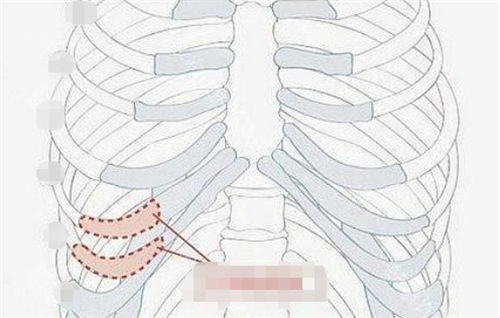 肋软骨隆鼻肋部位置展示图