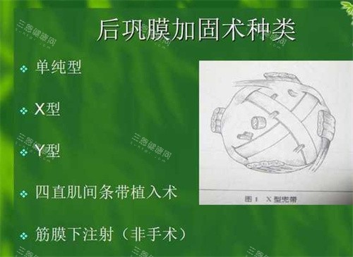 后巩膜加固术种类