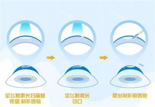 全飞秒激光眼睛照片 全飞秒激光眼睛照片