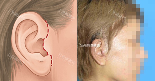 北京加减美v9手术优势不留疤痕