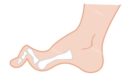脚趾过长弯曲