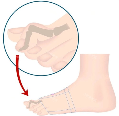 二脚趾过长放大图