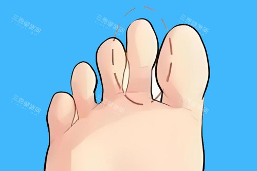 二脚趾长卡通图