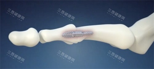 脚趾矫正手术内部固定