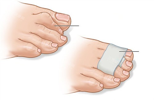 二脚趾矫正手术包扎