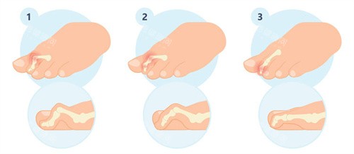 二脚趾矫正手术