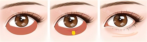 激光祛眼袋术过程