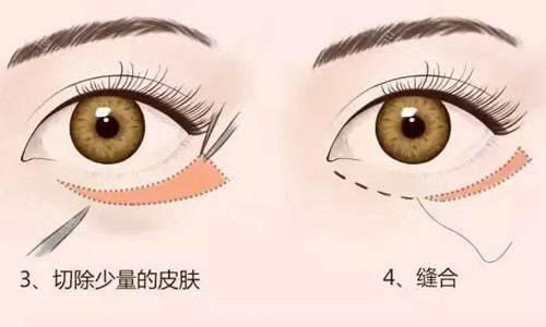 外切祛眼袋展示图