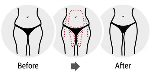 腰腹大腿吸脂前后对比图