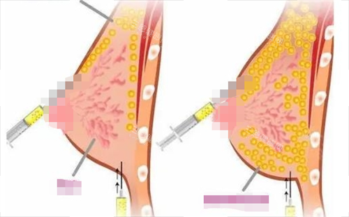 胸部脂肪填充过程呈现图