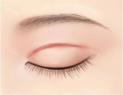 双眼皮肉条疤痕图 双眼皮肉条疤痕图