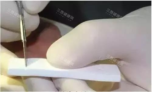 隆鼻手术雕刻中的膨体