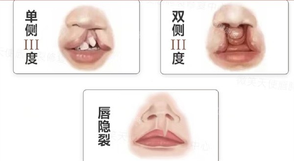 唇裂分型 唇裂分型