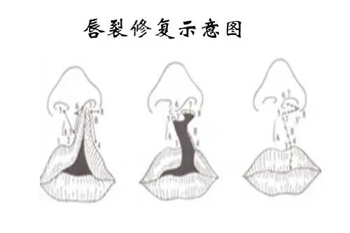 唇裂修复示意图.webp 唇裂修复示意图.webp