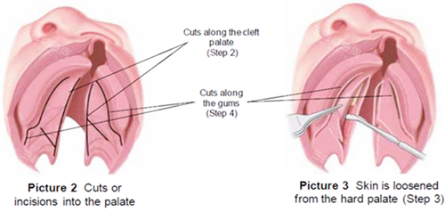 唇裂修复图片一览