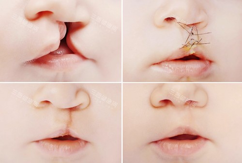 宝宝唇裂修复图示 宝宝唇裂修复图示