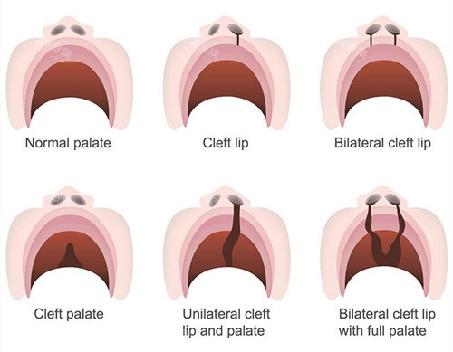 唇裂修复类型 唇裂修复类型