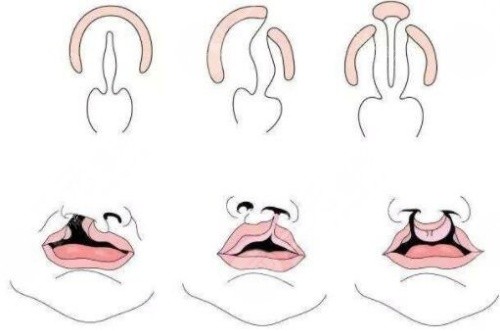唇裂鼻修复结构图 唇裂鼻修复结构图