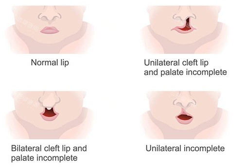 唇裂修复图片 唇裂修复图片