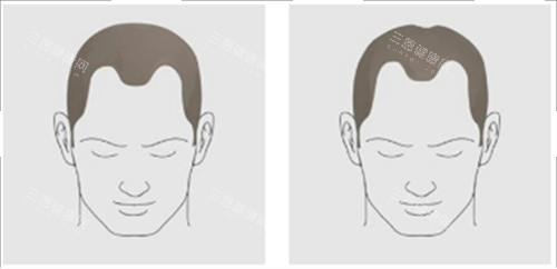 发际线后移类型