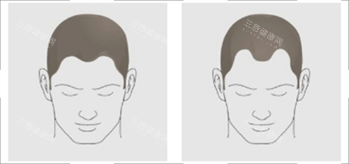 发际线对比