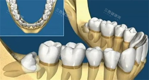 智齿牙齿动画图