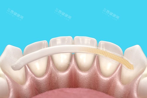 牙齿固定卡通图