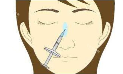 注射隆鼻正面 注射隆鼻正面