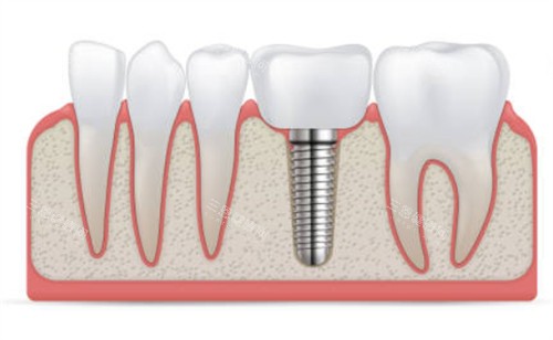 种植牙和临牙示意图 种植牙和临牙示意图
