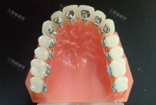 舌侧矫正假牙模拟展示 舌侧矫正假牙模拟展示