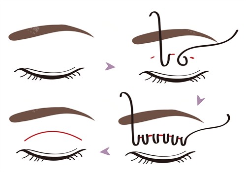 埋线双眼皮手术过程 埋线双眼皮手术过程