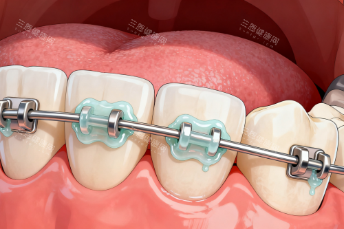 传统牙齿矫正方式展示图 传统牙齿矫正方式展示图
