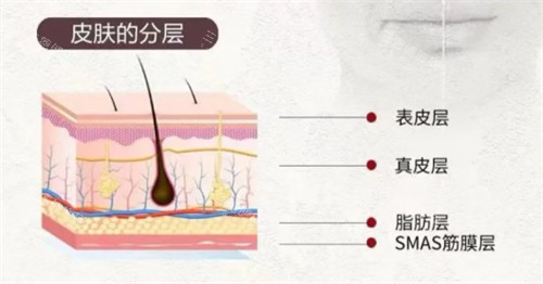 softwave索夫波适用皮肤层次 softwave索夫波适用皮肤层次