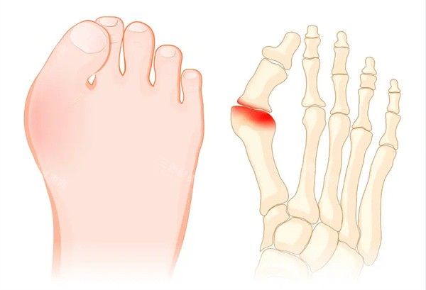 大脚骨矫正术 大脚骨矫正术