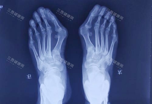 大脚骨拍片 大脚骨拍片