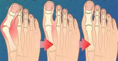 不同程度的大脚骨 不同程度的大脚骨