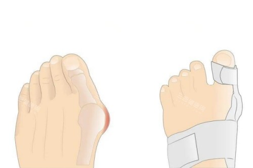 大脚骨矫正卡通图 大脚骨矫正卡通图