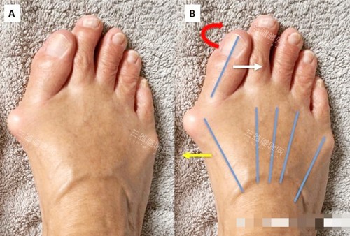 大脚骨对比图 大脚骨对比图