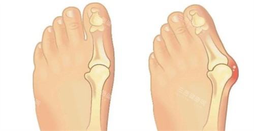 大脚骨手术 大脚骨手术