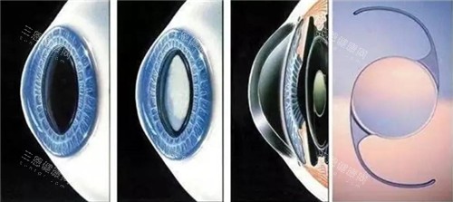 白内障晶体手术细节图 白内障晶体手术细节图