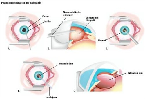 超声乳化白内障吸除术过程 超声乳化白内障吸除术过程