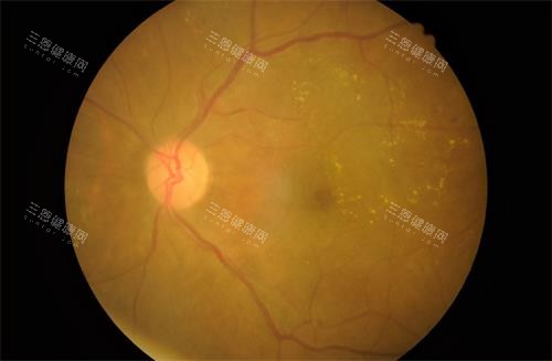 视网膜色素变性示意图