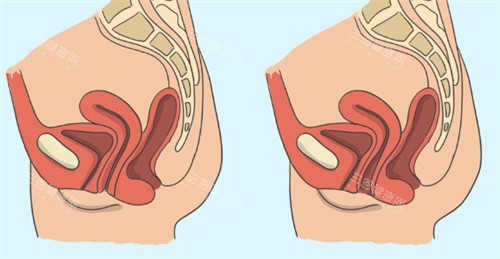 缩阴动画 缩阴动画