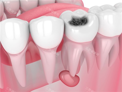 牙齿根管囊肿 牙齿根管囊肿