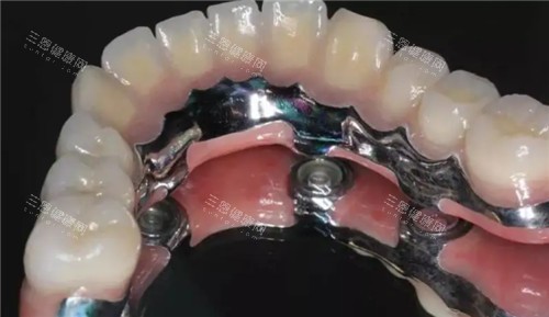 半口种植牙齿照片