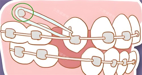 牙齿矫正卡通图片