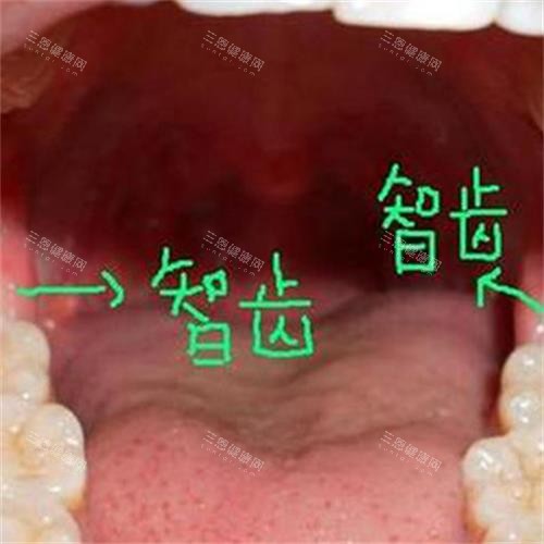 牙齿智齿所在位置 牙齿智齿所在位置