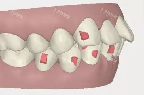 牙齿突出卡通图 牙齿突出卡通图